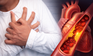 heart blockage and chest pain due to high cholesterol