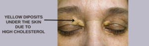 Yellowish cholesterol deposits on the skin near the eyes, known as xanthelasma, indicating high cholesterol levels.